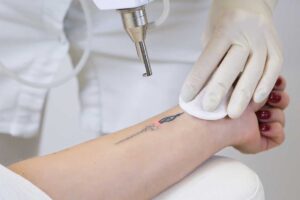 Détatouage laser : pourquoi il ne doit être pratiqué que par un médecin qualifié